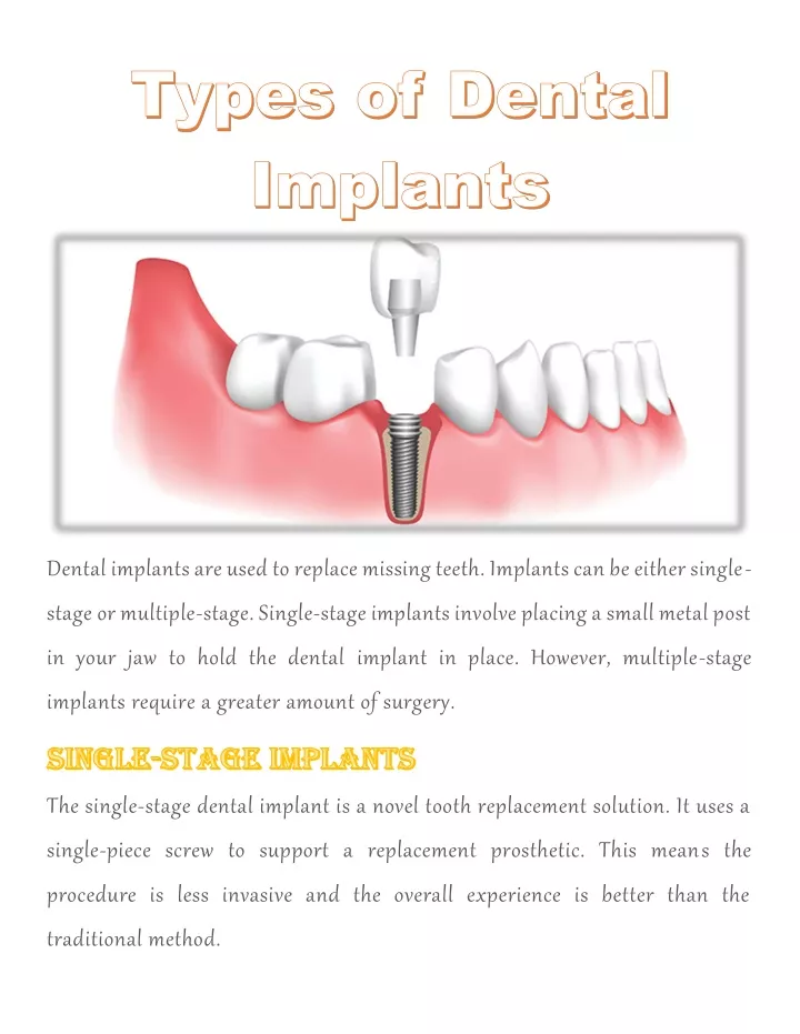 dental implants are used to replace missing teeth