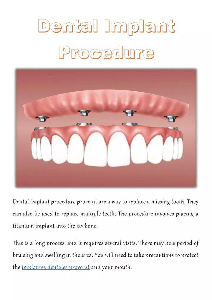 PPT - Dental Implant Procedure PowerPoint Presentation, free download ...