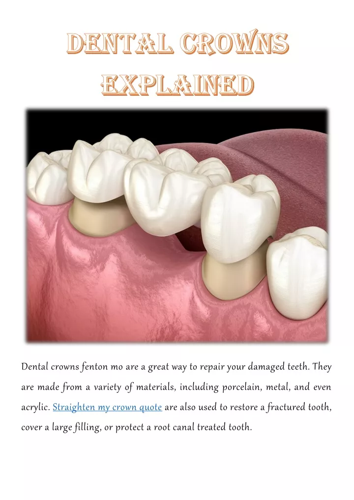 dental crowns fenton mo are a great way to repair