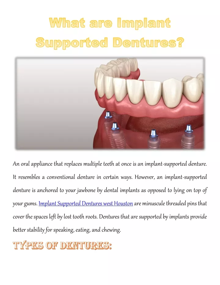 an oral appliance that replaces multiple teeth