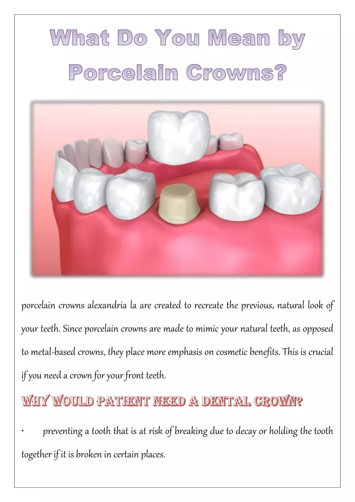 porcelain crowns alexandria la are created