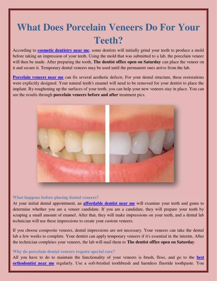 what does porcelain veneers do for your teeth