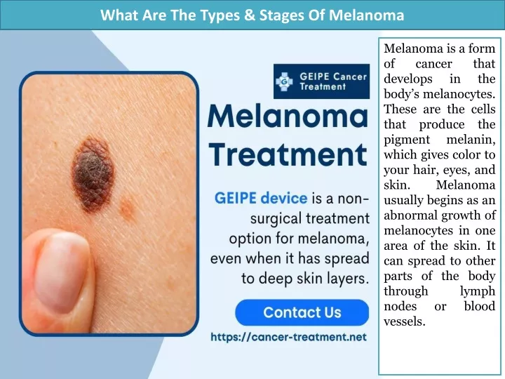 what are the types stages of melanoma