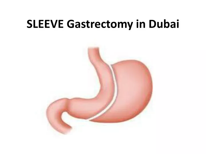 sleeve gastrectomy in dubai