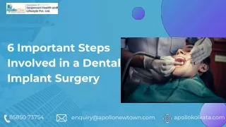 6 Important Steps Involved in a Dental Implant Surgery