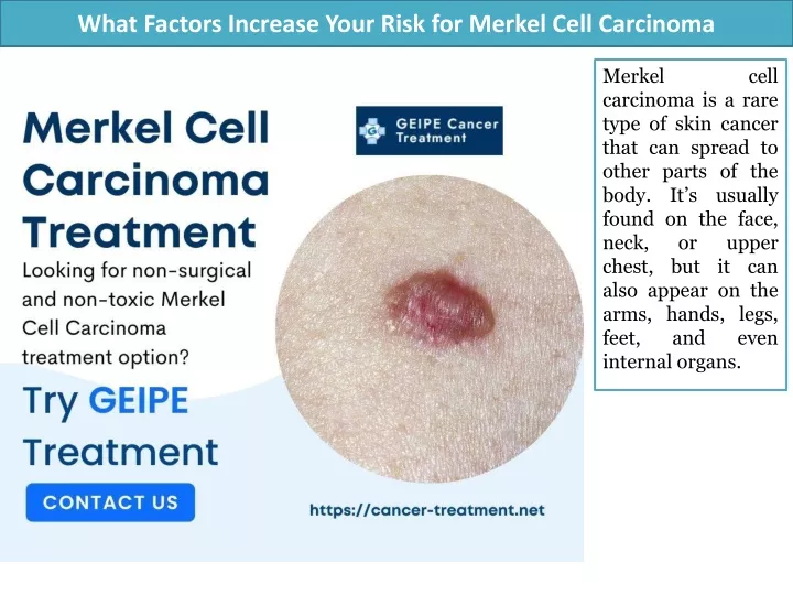 what factors increase your risk for merkel cell carcinoma