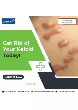Get Rid Of Your Keloid