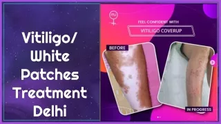White Patches Treatment Delhi