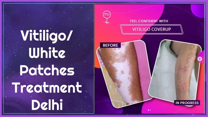 vitiligo white patches treatment delhi