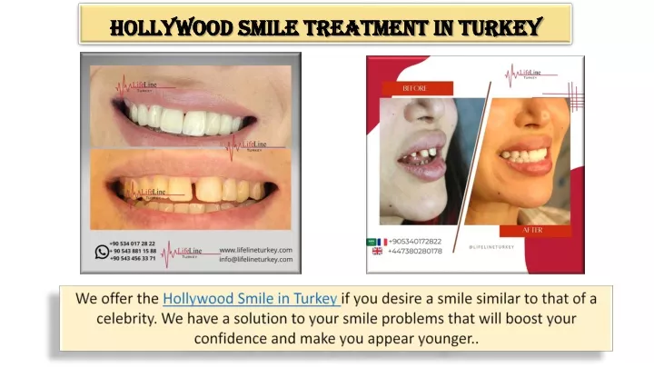 hollywood smile treatment in turkey