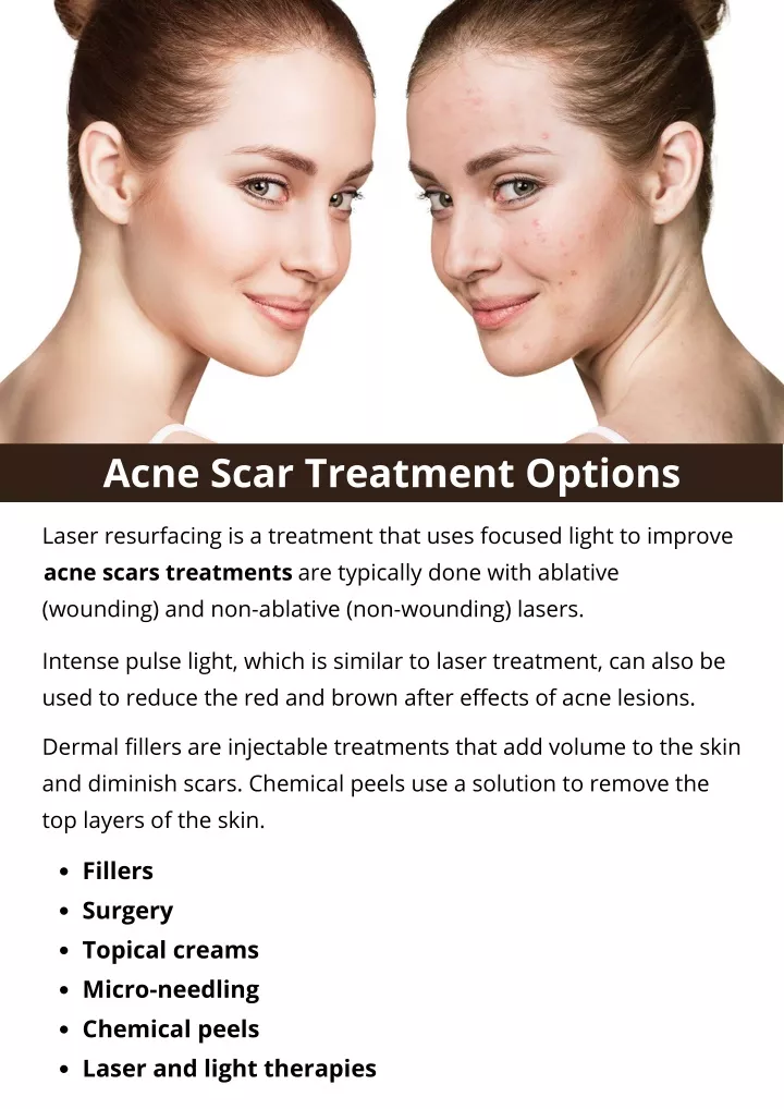 acne scar treatment options