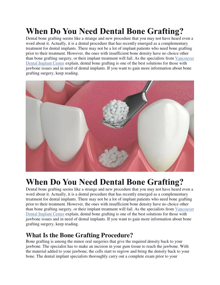 when do you need dental bone grafting dental bone