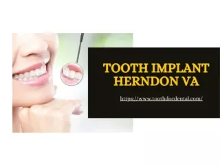 Tooth Implant Herndon VA - Tooth Doc Family Dentistry