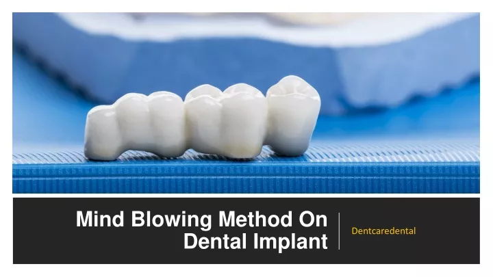 mind blowing method on dental implant