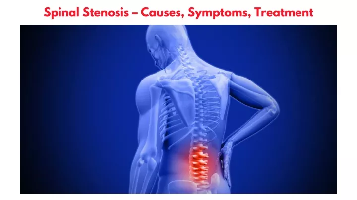 spinal stenosis causes symptoms treatment