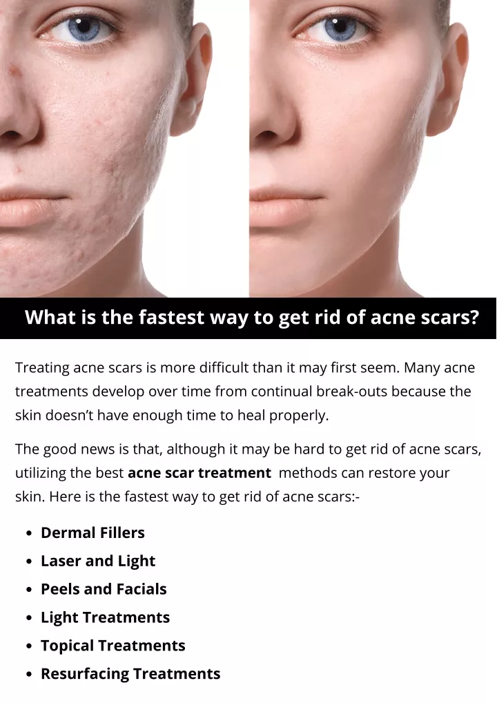 fastest way of getting rid of acne scars