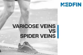 Varicose Veins Vs Spider Veins | Leg Vein Treatment | Medfin
