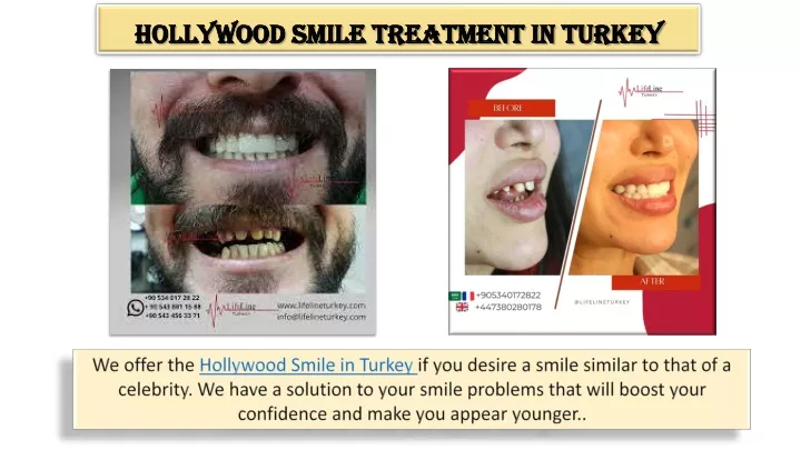 hollywood smile treatment in turkey