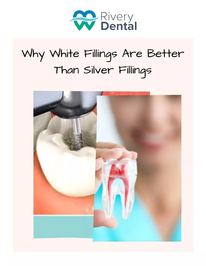 why white fillings are better than silver fillings