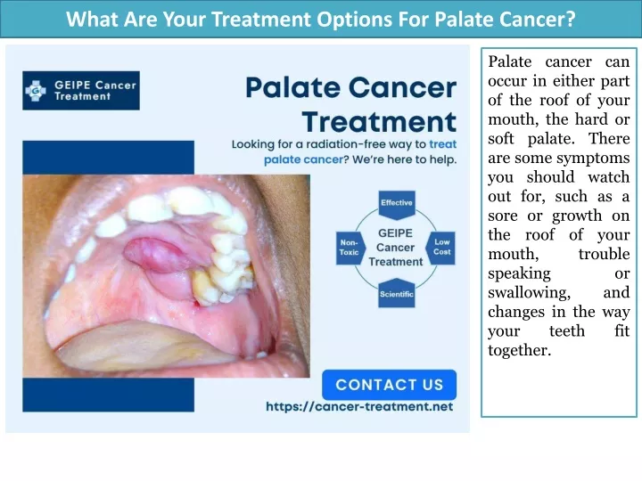 what are your treatment options for palate cancer