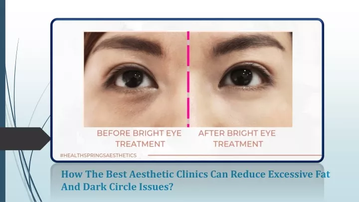how the best aesthetic clinics can reduce excessive fat and dark circle issues