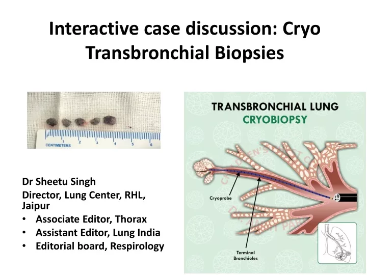 interactive case discussion cryo transbronchial biopsies