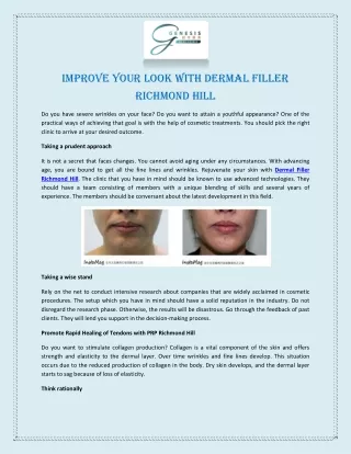Improve Your Look with Dermal Filler Richmond Hill