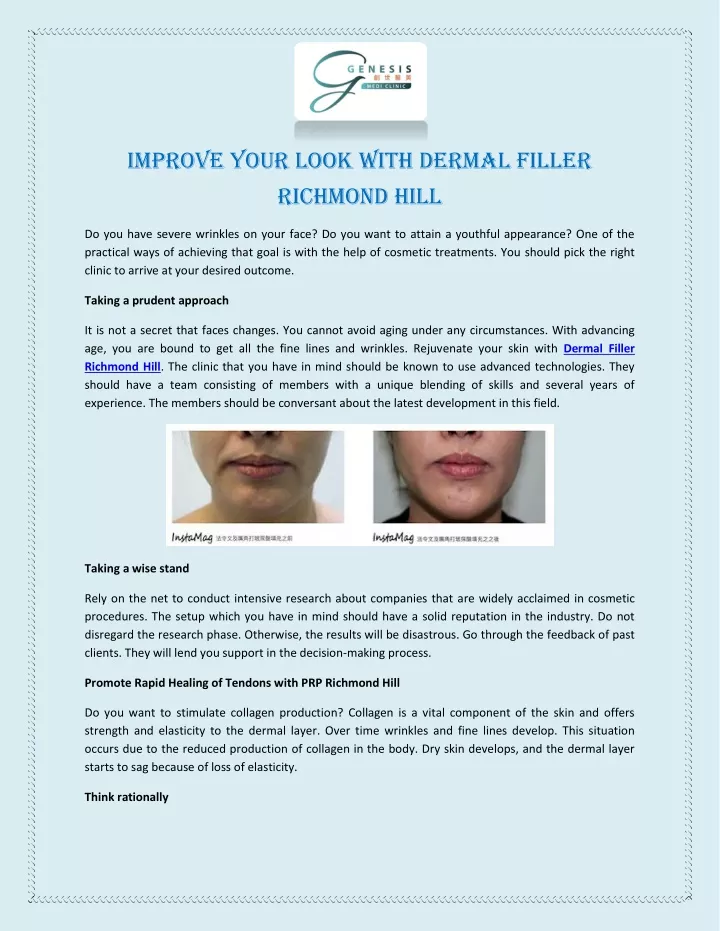 improve your look with dermal filler richmond hill
