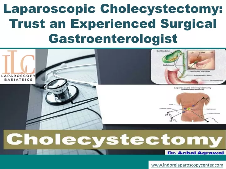 laparoscopic cholecystectomy trust an experienced