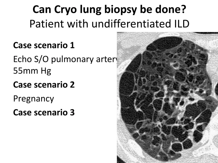 can c ryo lung biopsy be done patient with undifferentiated ild