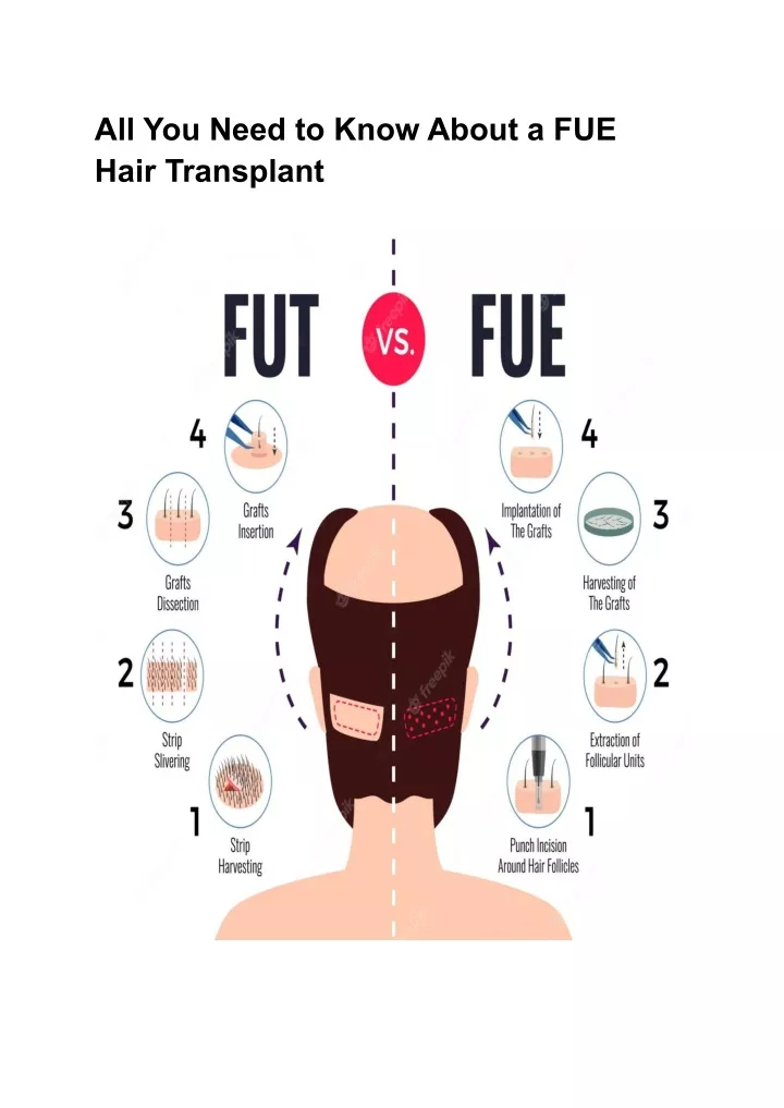 all you need to know about a fue hair transplant