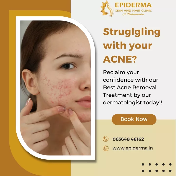 struglgling with your acne