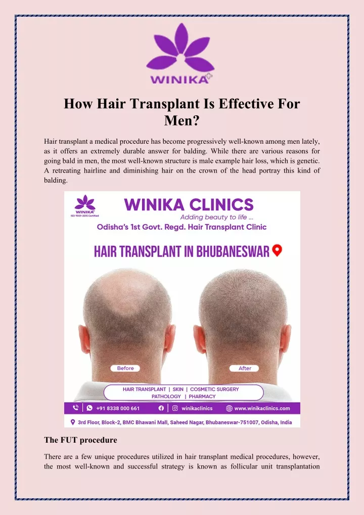 how hair transplant is effective for men