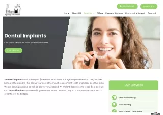 Affordable Dental Implants for Teeth in Auckland