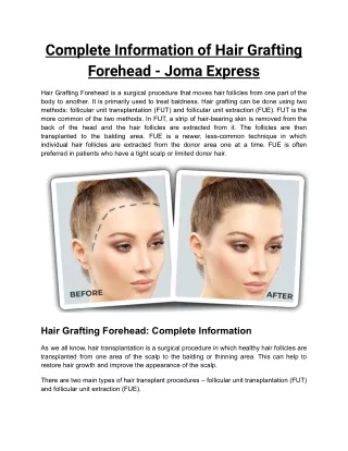Information of Hair Grafting Forehead - Joma Express