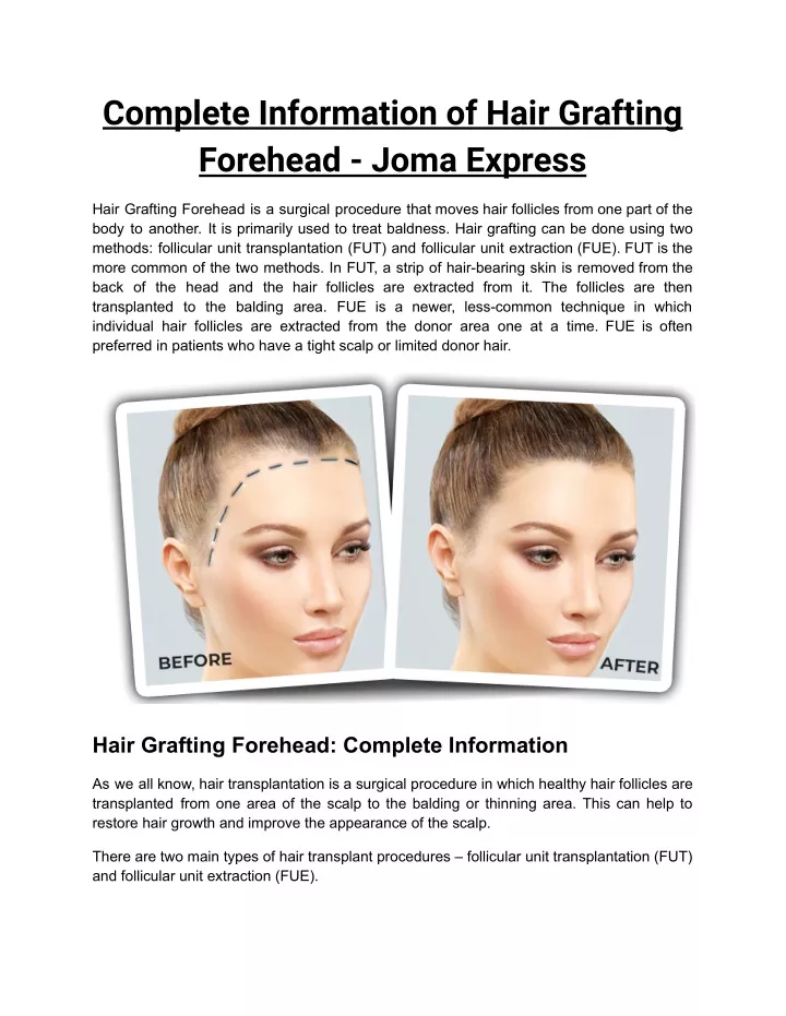 complete information of hair grafting forehead