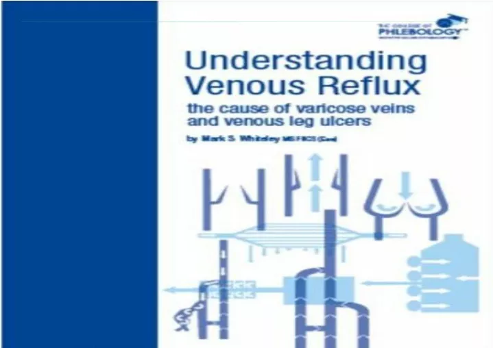 understanding venous reflux the cause of varicose