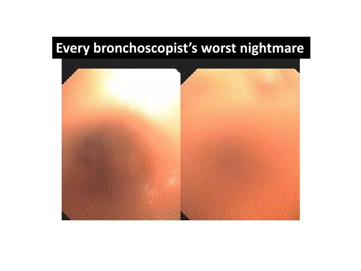 every bronchoscopist s worst nightmare