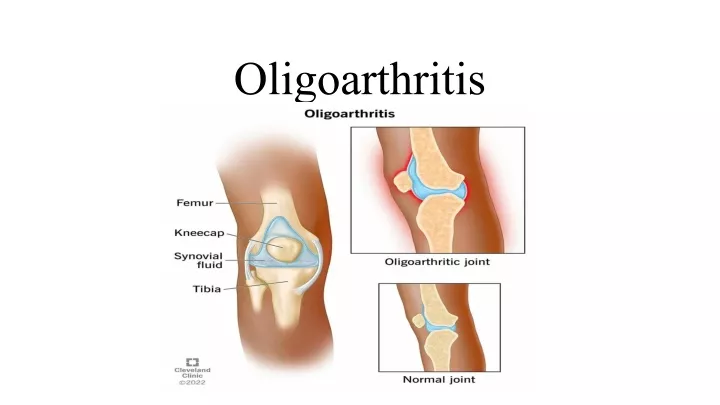 oligoarthritis