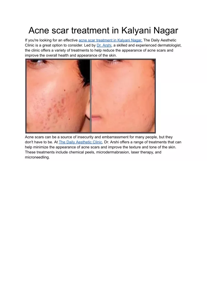 acne scar treatment in kalyani nagar
