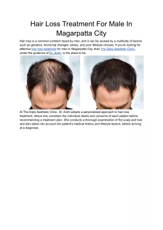 Hair Loss Treatment For Male In Magarpatta City