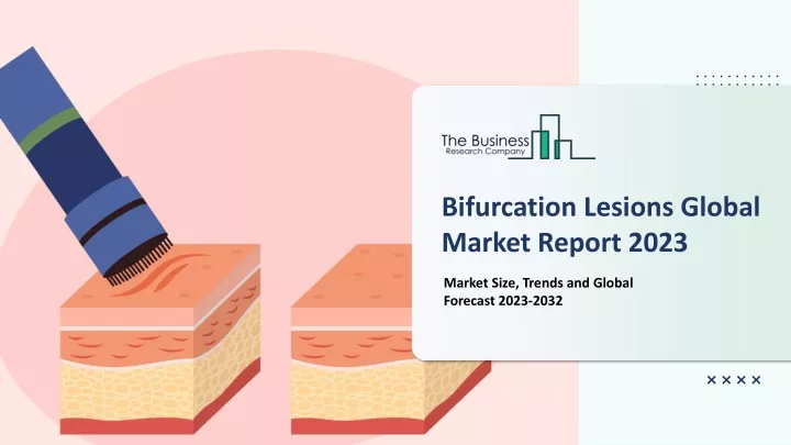 bifurcation lesions global market report 2023