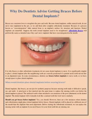 Why Do Dentists Advise Getting Braces Before Dental Implants?