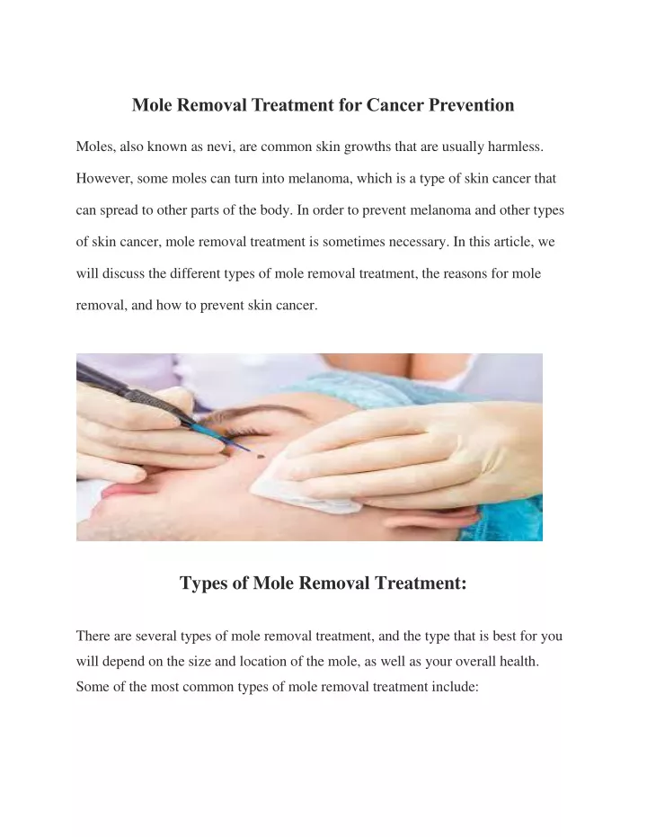 mole removal treatment for cancer prevention
