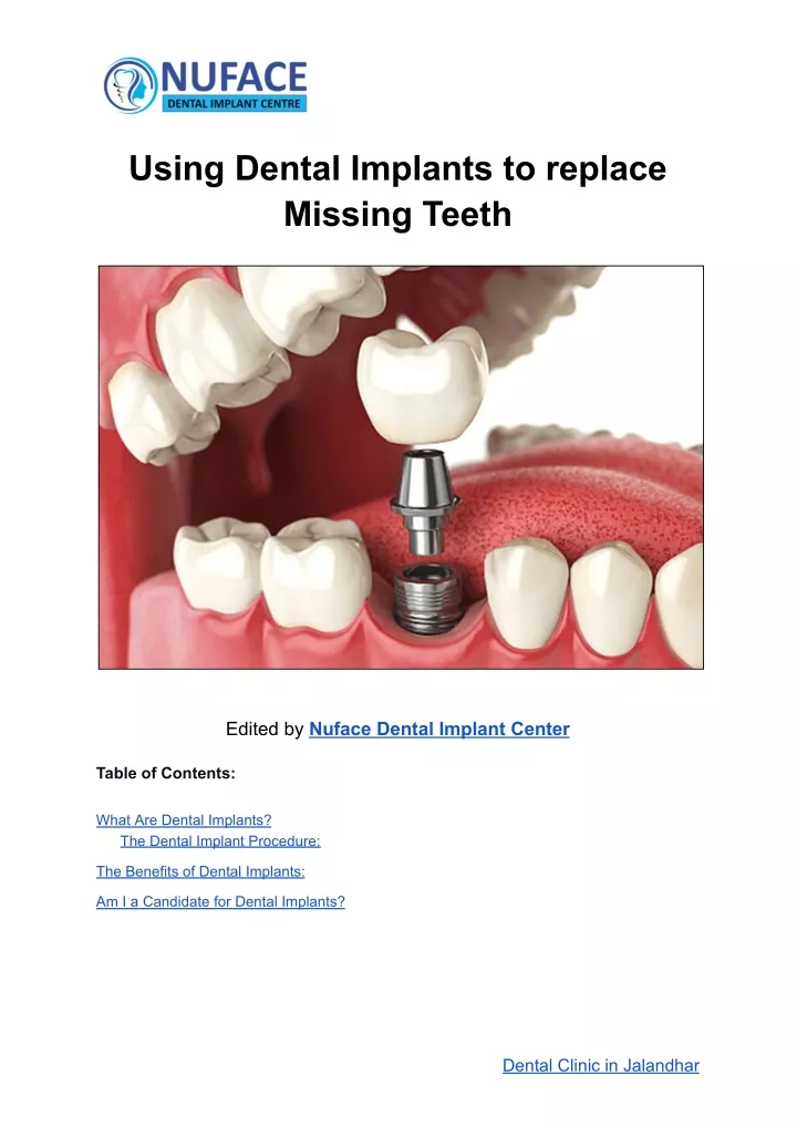 using dental implants to replace missing teeth