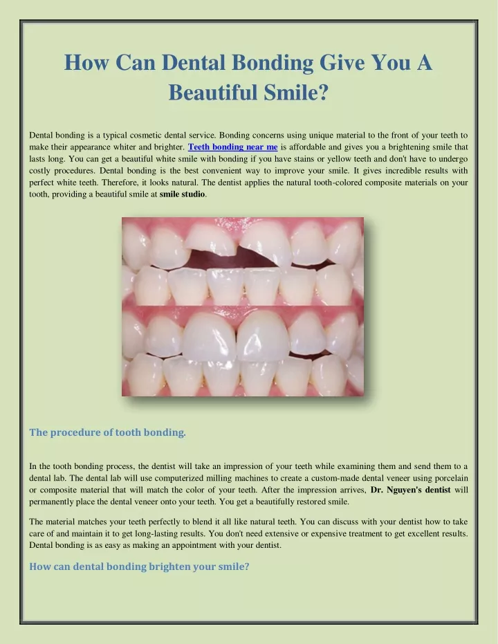 how can dental bonding give you a beautiful smile