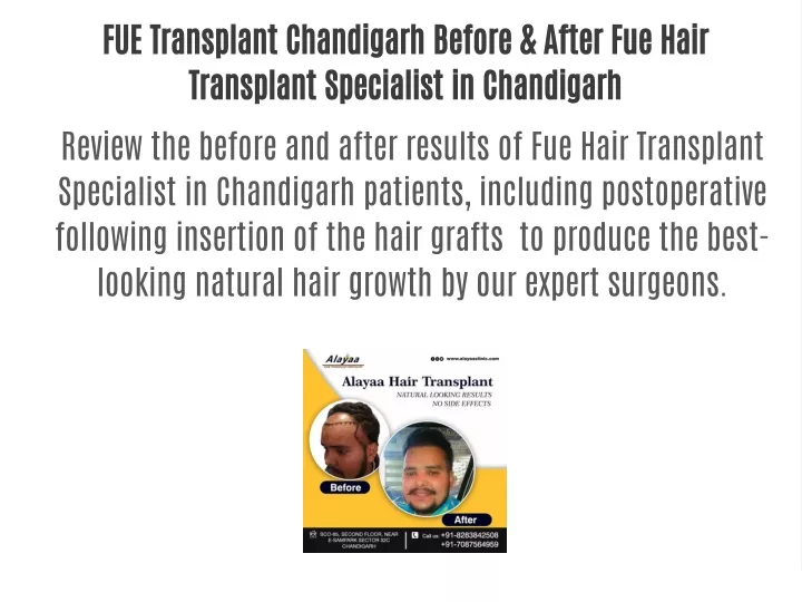 fue transplant chandigarh before after fue hair