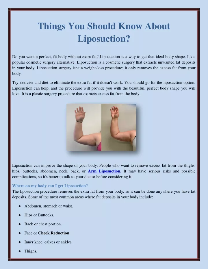 things you should know about liposuction