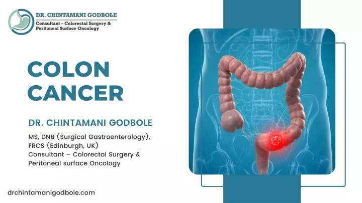 Ppt Colon Cancer Dr Chintamani Godbole Powerpoint Presentation