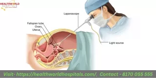 After a Laparoscopic Sleeve Resection Surgery Nutritional Dos and Don'ts  HealthWorldHospitals